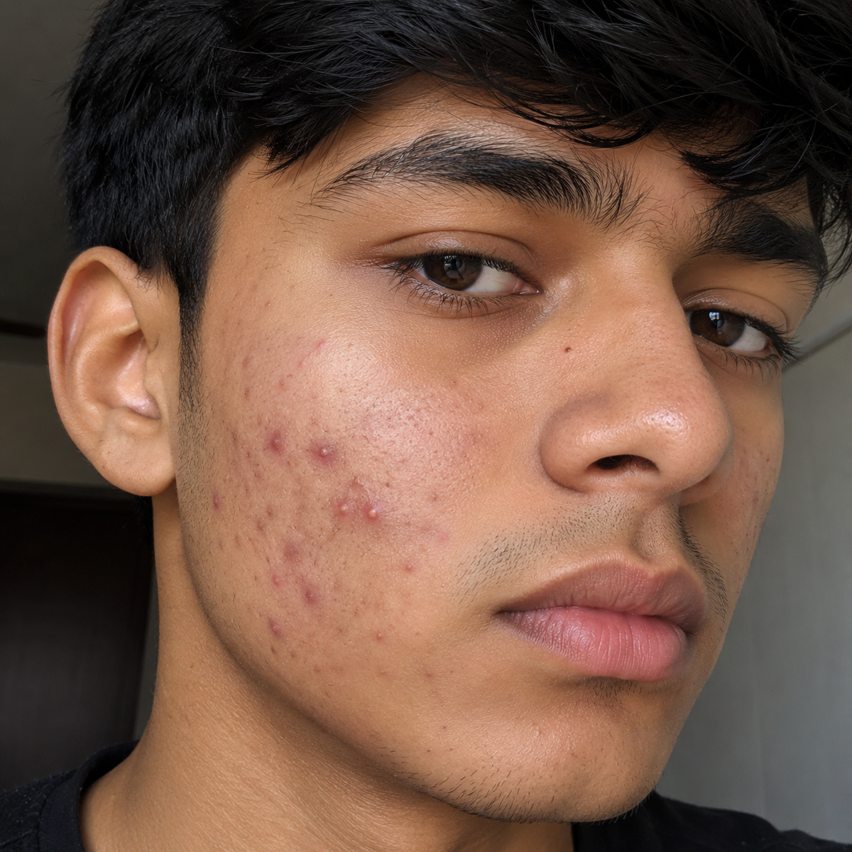 ACNE